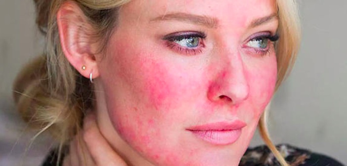 Featured image of post Rosacea için Doğal Tedaviler ve Ev İlaçları