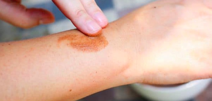 Featured image of post Doğal DIY Bronzlaştırıcı Losyon
