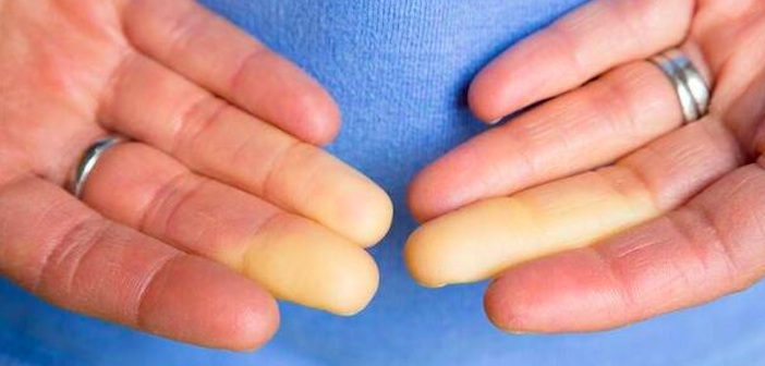 Featured image of post Raynaud Hastalığı Doğal Olarak Nasıl Tedavi Edilir?